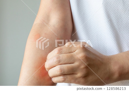 Young asian man itching and scratching on arm from allergic itchy dry skin eczema dermatitis insect bites 128586213
