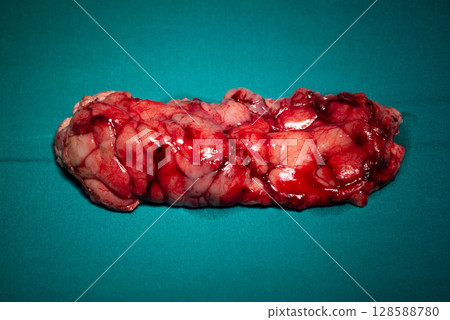 Resected Astrocytoma Brain Tumor Specimen 128588780
