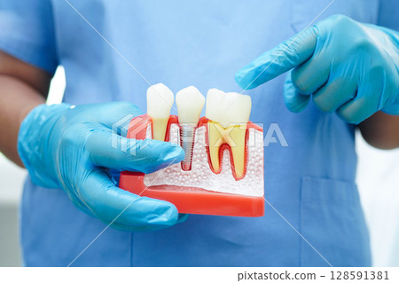 Doctor hold dental implant, artificial tooth roots into jaw, root canal of dental treatment, gum disease, teeth model for dentist studying about dentistry. Doctor hold dental implant, artificial tooth roots into jaw, root canal of dental treatment, gum disease, teeth model for dentist studying about dentistry. 128591381