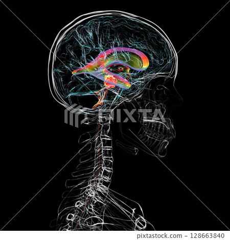 A brain tumor causing hydrocephalus, 3D illustration 128663840