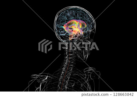 A brain tumor causing hydrocephalus, 3D illustration 128663842