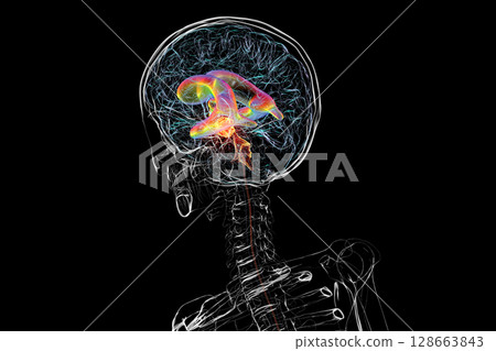 A brain tumor causing hydrocephalus, 3D illustration 128663843