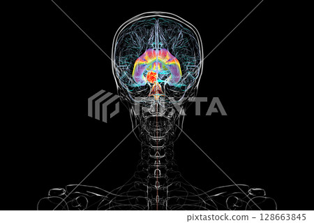 A brain tumor causing hydrocephalus, 3D illustration 128663845