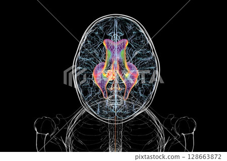 A brain tumor causing hydrocephalus, 3D illustration 128663872