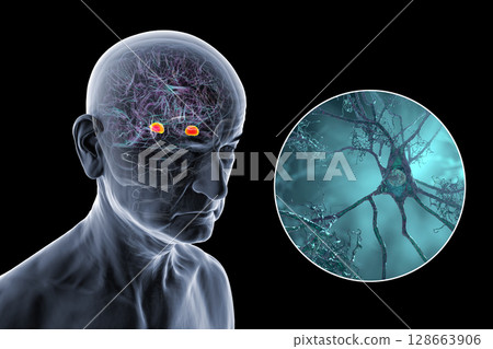 Senior person with Alzheimer's disease, 3D illustration showing highlighted amygdala and close-up view of amygdala neurons affected by Alzheimer' pathology, including tau tangles and amyloid plaques Senior person with Alzheimer's disease, 3D illustration showing highlighted amygdala and close-up view of amygdala neurons affected by Alzheimer' pathology, including tau tangles and amyloid plaques 128663906