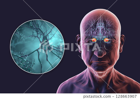 Senior person with Alzheimer's disease, 3D illustration showing highlighted amygdala and close-up view of amygdala neurons affected by Alzheimer' pathology, including tau tangles and amyloid plaques Senior person with Alzheimer's disease, 3D illustration showing highlighted amygdala and close-up view of amygdala neurons affected by Alzheimer' pathology, including tau tangles and amyloid plaques 128663907