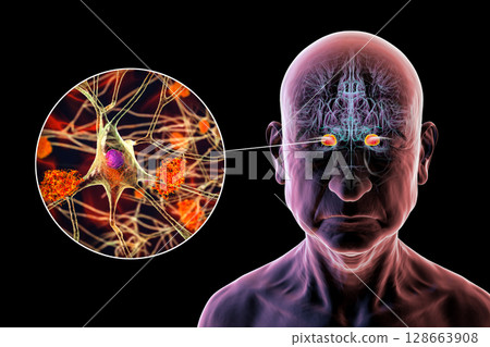 Senior person with Alzheimer's disease, 3D illustration showing highlighted amygdala and close-up view of amygdala neurons affected by Alzheimer' pathology, including tau tangles and amyloid plaques Senior person with Alzheimer's disease, 3D illustration showing highlighted amygdala and close-up view of amygdala neurons affected by Alzheimer' pathology, including tau tangles and amyloid plaques 128663908