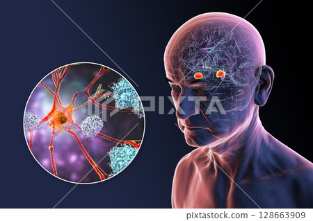 Senior person with Alzheimer's disease, 3D illustration showing highlighted amygdala and close-up view of amygdala neurons affected by Alzheimer' pathology, including tau tangles and amyloid plaques Senior person with Alzheimer's disease, 3D illustration showing highlighted amygdala and close-up view of amygdala neurons affected by Alzheimer' pathology, including tau tangles and amyloid plaques 128663909