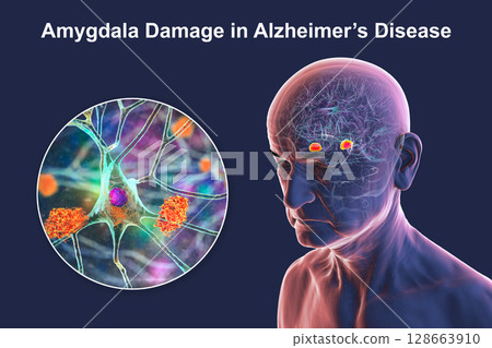Senior person with Alzheimer's disease, 3D illustration showing highlighted amygdala and close-up view of amygdala neurons affected by Alzheimer' pathology, including tau tangles and amyloid plaques 128663910
