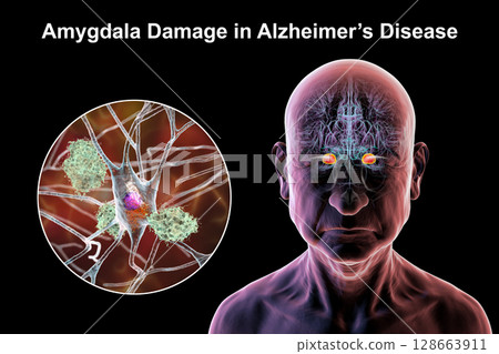 Senior person with Alzheimer's disease, 3D illustration showing highlighted amygdala and close-up view of amygdala neurons affected by Alzheimer' pathology, including tau tangles and amyloid plaques 128663911