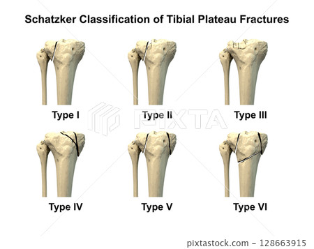 Schatzker classification of tibial plateau fractures, types I to VI, used to assess fracture patterns and severity in proximal tibia injuries, 3D illustration Schatzker classification of tibial plateau fractures, types I to VI, used to assess fracture patterns and severity in proximal tibia injuries, 3D illustration 128663915