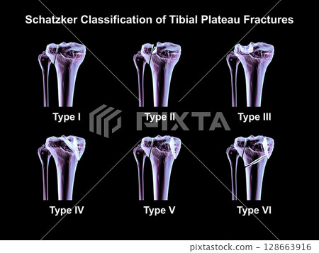 Schatzker classification of tibial plateau fractures, types I to VI, used to assess fracture patterns and severity in proximal tibia injuries, 3D illustration Schatzker classification of tibial plateau fractures, types I to VI, used to assess fracture patterns and severity in proximal tibia injuries, 3D illustration 128663916