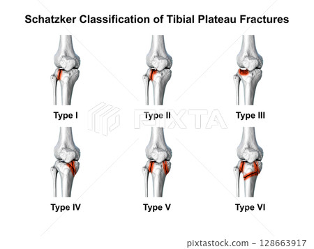 Schatzker classification of tibial plateau fractures, types I to VI, used to assess fracture patterns and severity in proximal tibia injuries, 3D illustration Schatzker classification of tibial plateau fractures, types I to VI, used to assess fracture patterns and severity in proximal tibia injuries, 3D illustration 128663917