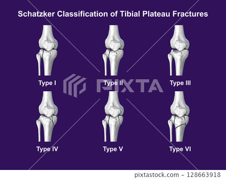 Schatzker classification of tibial plateau fractures, types I to VI, used to assess fracture patterns and severity in proximal tibia injuries, 3D illustration Schatzker classification of tibial plateau fractures, types I to VI, used to assess fracture patterns and severity in proximal tibia injuries, 3D illustration 128663918