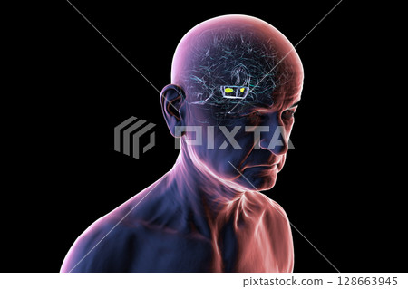 Human brain with degenerated substantia nigra in Parkinson's disease, showing loss of pigmented neurons in the midbrain related to motor dysfunction, 3D illustration. Human brain with degenerated substantia nigra in Parkinson's disease, showing loss of pigmented neurons in the midbrain related to motor dysfunction, 3D illustration. 128663945
