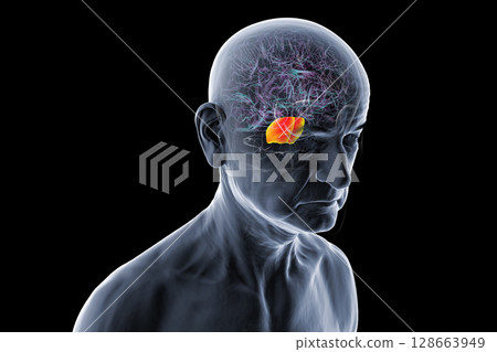 Human brain in a senior person with highlighted pons, essential for motor control and sleep, often impacted in age-related disorders like Parkinson's and vascular dementia, 3D illustration. Human brain in a senior person with highlighted pons, essential for motor control and sleep, often impacted in age-related disorders like Parkinson's and vascular dementia, 3D illustration. 128663949