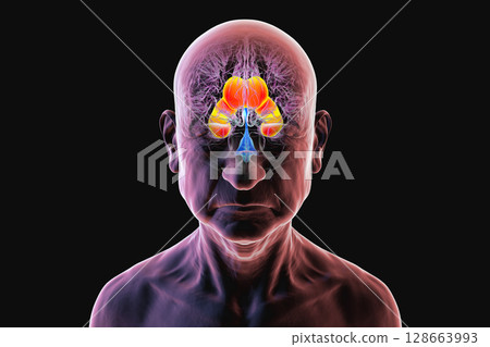 Enlarged lateral ventricles of the brain, 3D illustration 128663993