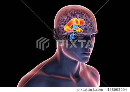 Enlarged lateral ventricles of the brain, 3D illustration 128663994