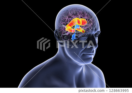 Enlarged lateral ventricles of the brain, 3D illustration Enlarged lateral ventricles of the brain, 3D illustration 128663995
