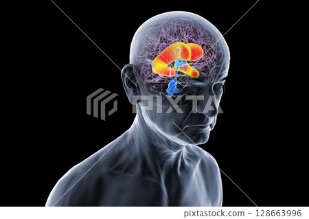 Enlarged lateral ventricles of the brain, 3D illustration 128663996