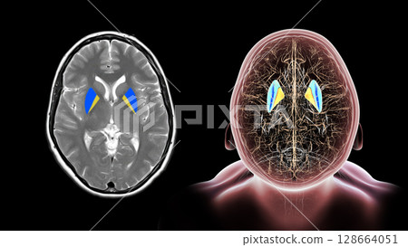 Human brain with highlighted putamen and globus pallidus, key basal ganglia structures involved in motor control and coordination, 3D illustration and colored MRI. 128664051