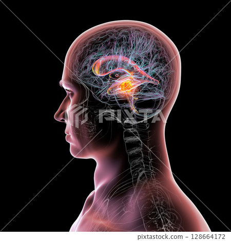 A brain tumor causing hydrocephalus, 3D illustration 128664172