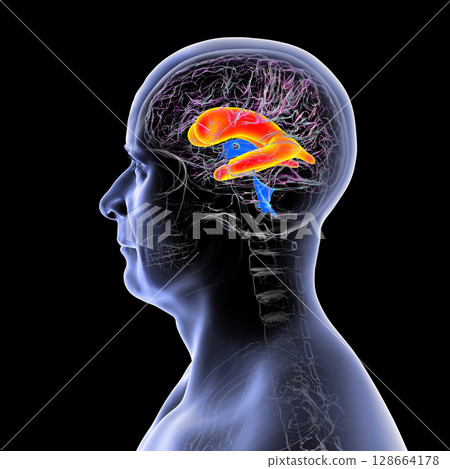 Enlarged lateral ventricles of the brain, 3D illustration Enlarged lateral ventricles of the brain, 3D illustration 128664178