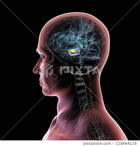 Human brain with degenerated substantia nigra in Parkinson's disease, showing loss of pigmented neurons in the midbrain related to motor dysfunction, 3D illustration. 128664228