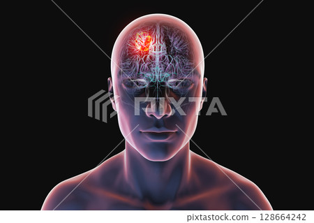 Brain tumor, 3D illustration. Meningioma, glioma, astrocytoma, and other brain tumors 128664242