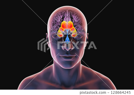 Enlarged lateral ventricles of the brain, 3D illustration Enlarged lateral ventricles of the brain, 3D illustration 128664245