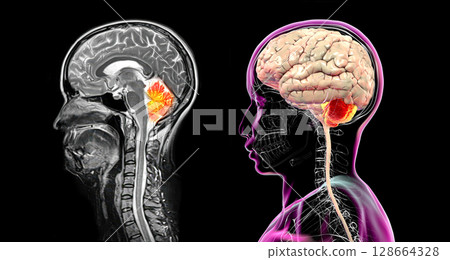 Cerebellum, 3D illustration and colored MRI composite showing brain anatomy with highlighted cerebellum, important for coordination, balance, and motor control. Cerebellum, 3D illustration and colored MRI composite showing brain anatomy with highlighted cerebellum, important for coordination, balance, and motor control. 128664328