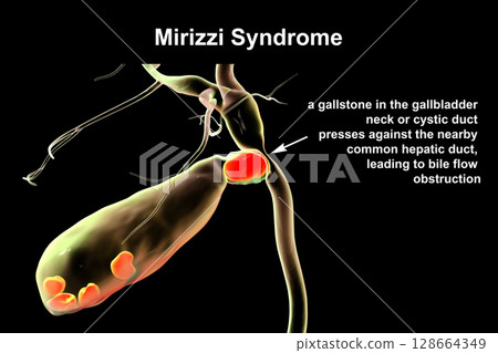 Mirizzi syndrome, 3D illustration showing compression of the common hepatic duct by an impacted gallstone in the cystic duct, causing obstructive jaundice and inflammation. 128664349