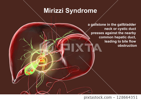 Mirizzi syndrome, 3D illustration showing compression of the common hepatic duct by an impacted gallstone in the cystic duct, causing obstructive jaundice and inflammation. 128664351
