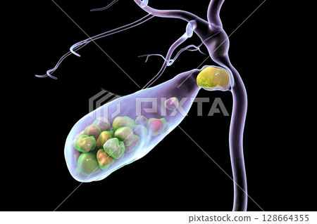 Gallbladder with stones, 3D illustration showing cholelithiasis. Gallstones can block bile flow and cause pain, inflammation, or infection requiring medical or surgical treatment. Gallbladder with stones, 3D illustration showing cholelithiasis. Gallstones can block bile flow and cause pain, inflammation, or infection requiring medical or surgical treatment. 128664355
