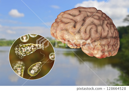 Brain-eating amoeba infection, naegleriasis 128664528