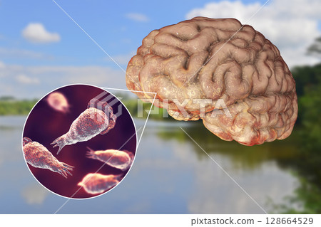 Brain-eating amoeba infection, naegleriasis 128664529