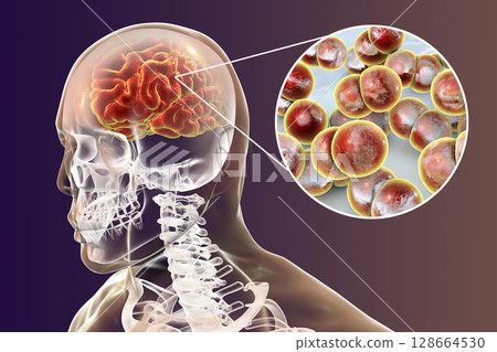 Brain infection with Neisseria meningitidis bacteria 128664530