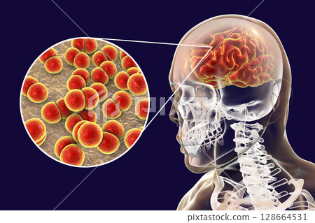 Brain infection with Neisseria meningitidis bacteria 128664531
