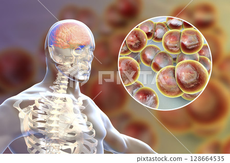 Brain infection with Neisseria meningitidis bacteria 128664535