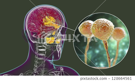 Rhinocerebral mucormycosis, a brain lesion and sinusitis caused by fungi Mucor 128664561