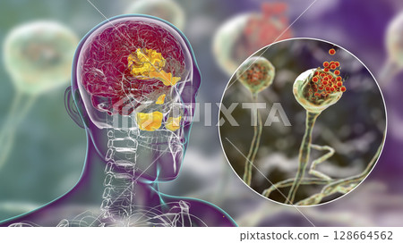 Rhinocerebral mucormycosis, a brain lesion and sinusitis caused by fungi Mucor 128664562