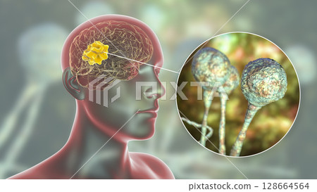 Brain mucormycosis, a brain lesion caused by fungi Mucor Brain mucormycosis, a brain lesion caused by fungi Mucor 128664564