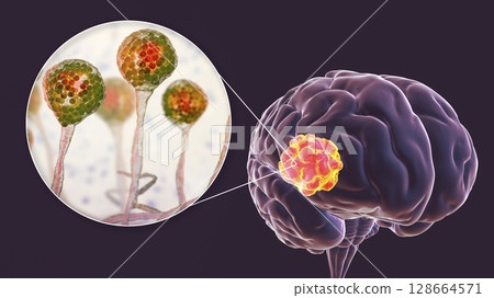 Brain mucormycosis, a brain lesion caused by fungi Mucor, also known as black fungus, with close-up view of the fungi, 3D illustration Brain mucormycosis, a brain lesion caused by fungi Mucor, also known as black fungus, with close-up view of the fungi, 3D illustration 128664571