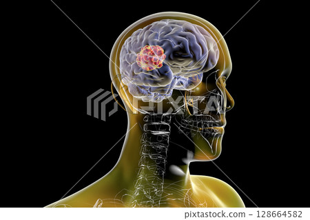 Brain mucormycosis, a brain lesion caused by fungi Mucor, also known as black fungus 128664582