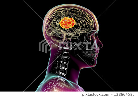Brain mucormycosis, a brain lesion caused by fungi Mucor, also known as black fungus 128664583