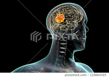 Brain mucormycosis, a brain lesion caused by fungi Mucor, also known as black fungus Brain mucormycosis, a brain lesion caused by fungi Mucor, also known as black fungus 128664585