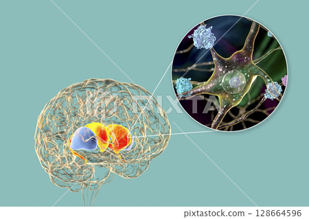Neuronal inclusions in Huntington's disease, 3D illustration 128664596