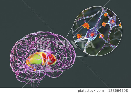 Neuronal inclusions in Huntington's disease, 3D illustration Neuronal inclusions in Huntington's disease, 3D illustration 128664598