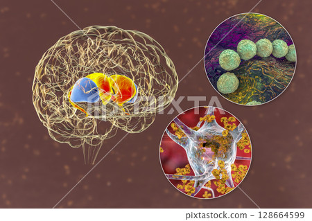 Brain disease due to streptococcal infection and anti-basal ganglia antibodies, 3D conceptual illustration 128664599