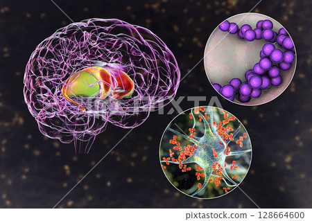Brain disease due to streptococcal infection and anti-basal ganglia antibodies, 3D conceptual illustration 128664600